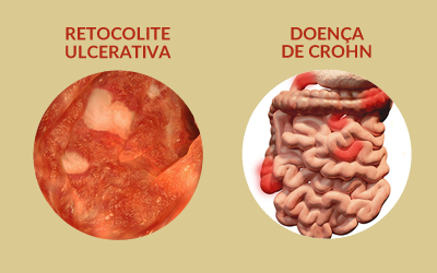 Orientações Dietéticas nas Doenças Inflamatórias Intestinais: Retocolite Ulcerativa e Doença De Crohn